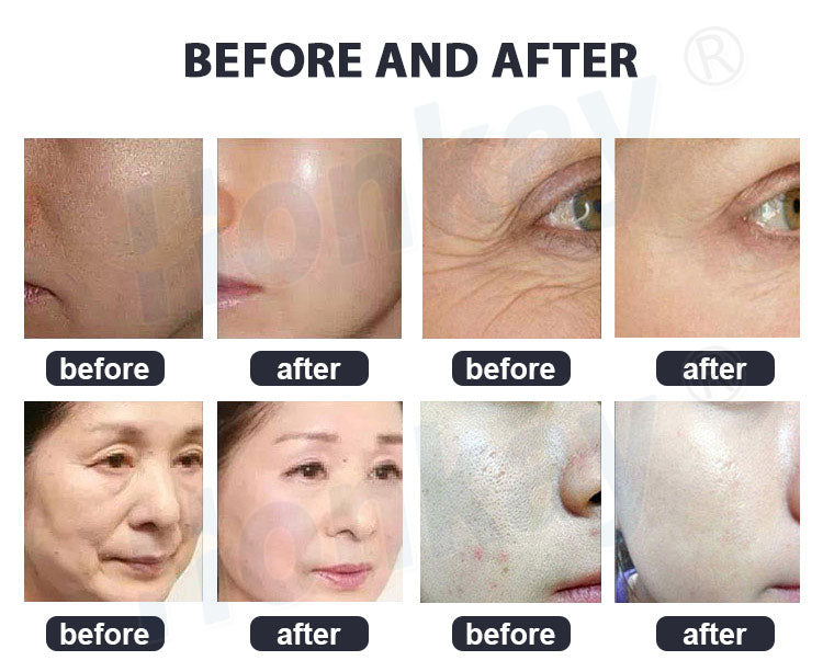 PDT Light Therapy Machine for Acne, Anti-Aging & Skin Rejuvenation