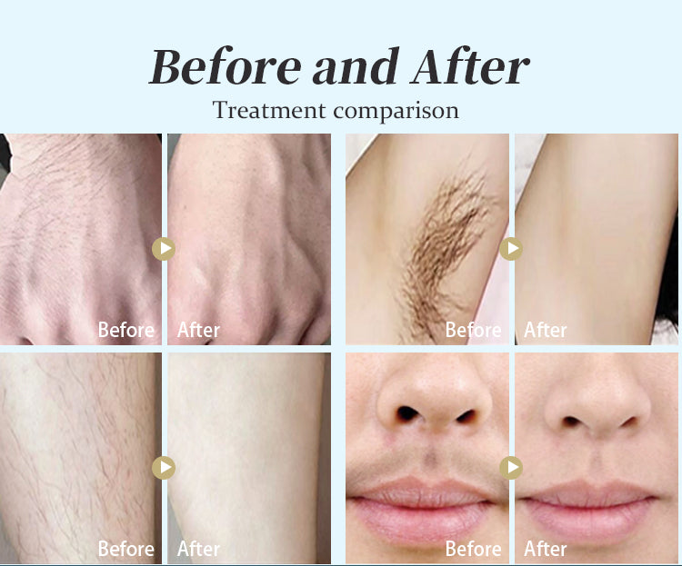Portable 808 nm Diode Laser Diode 808 Laser Hair Removal laser diode Machine