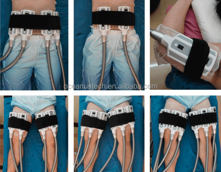 Cryolipolysis Slimming Machine for Non-Invasive Fat Loss