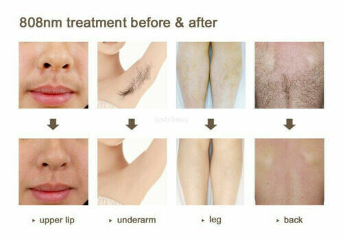 Painless 808nm Diode Laser Permanent Hair Removal Salon Beauty Machine