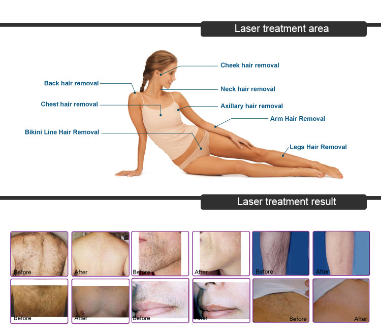 Portable 600W laser diode hair removal laser diodo 808nm+ 1064nm diode laser hair removal price