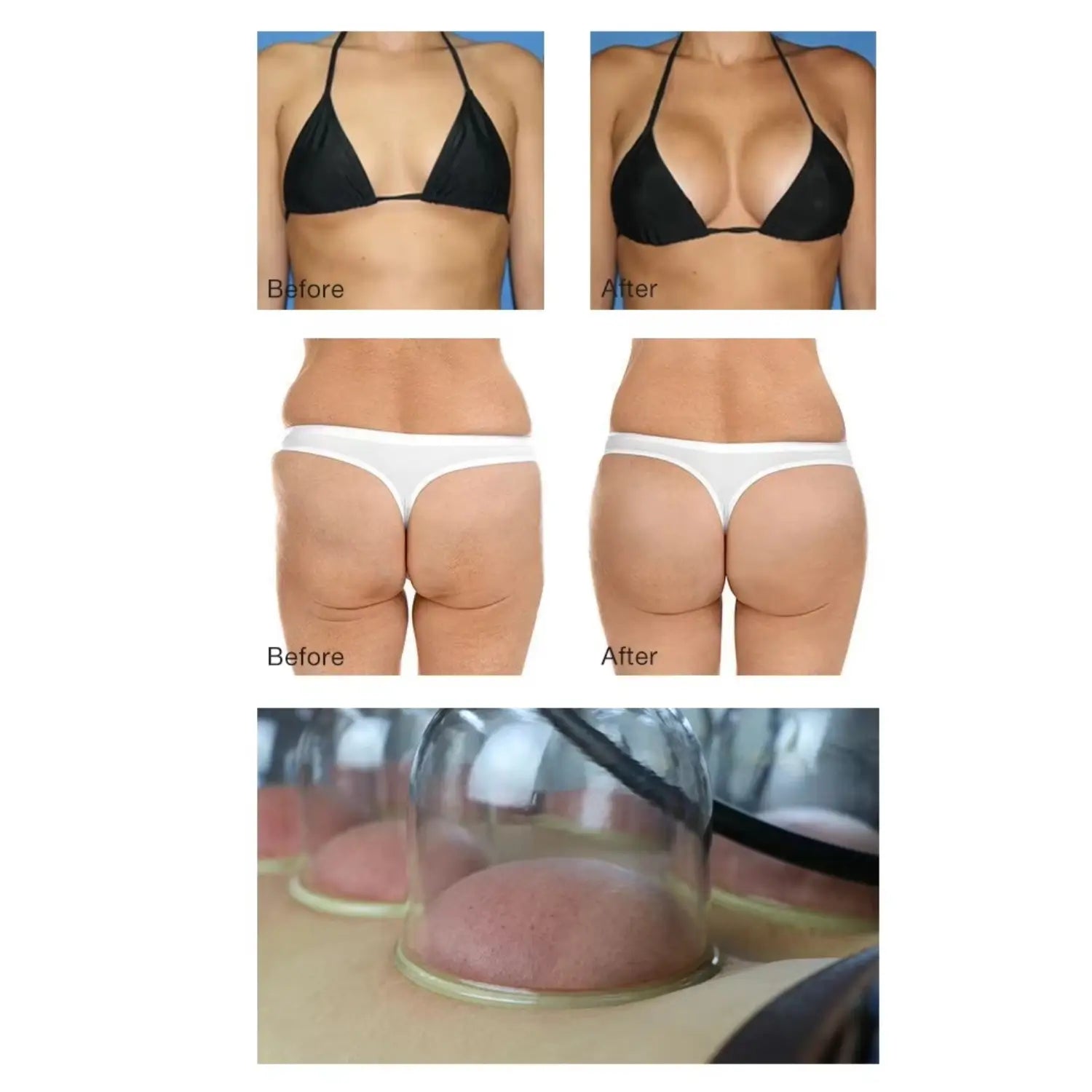 Butt Vacuum Therapy Machine – Brazilian Lifting & Body Contouring Device