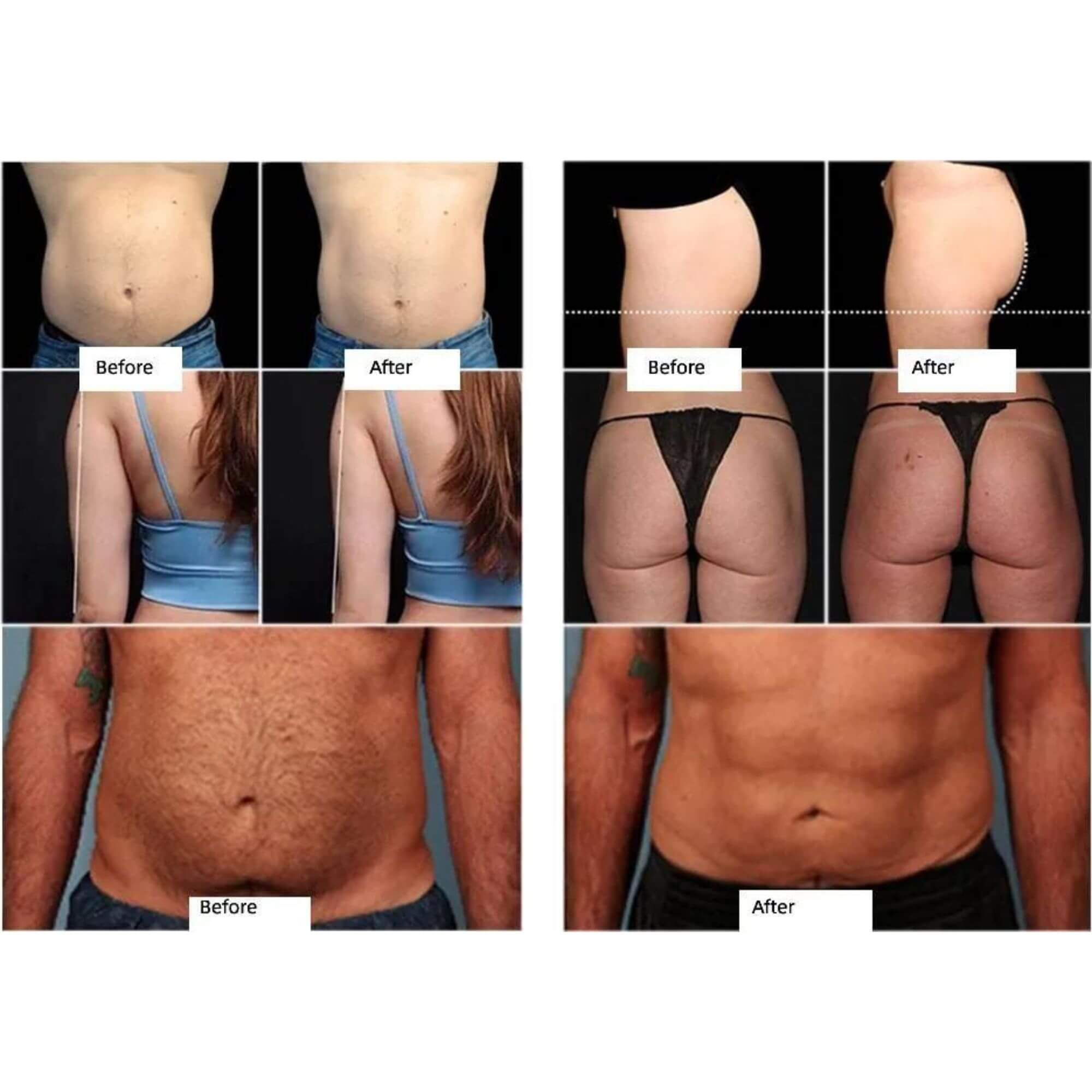 Best Emsculpt Home Machine for Sale - Lazzybeauty