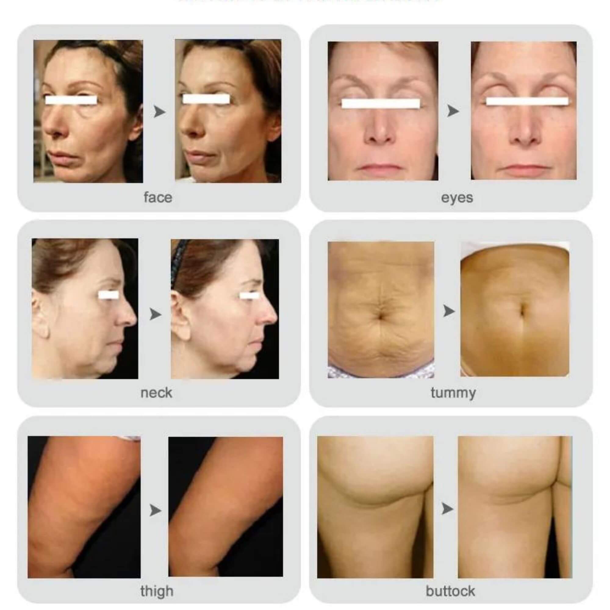 Professional RF Needling Machine for Skin Tightening & Wrinkle Reduction (Max. 3.5mm Depth)