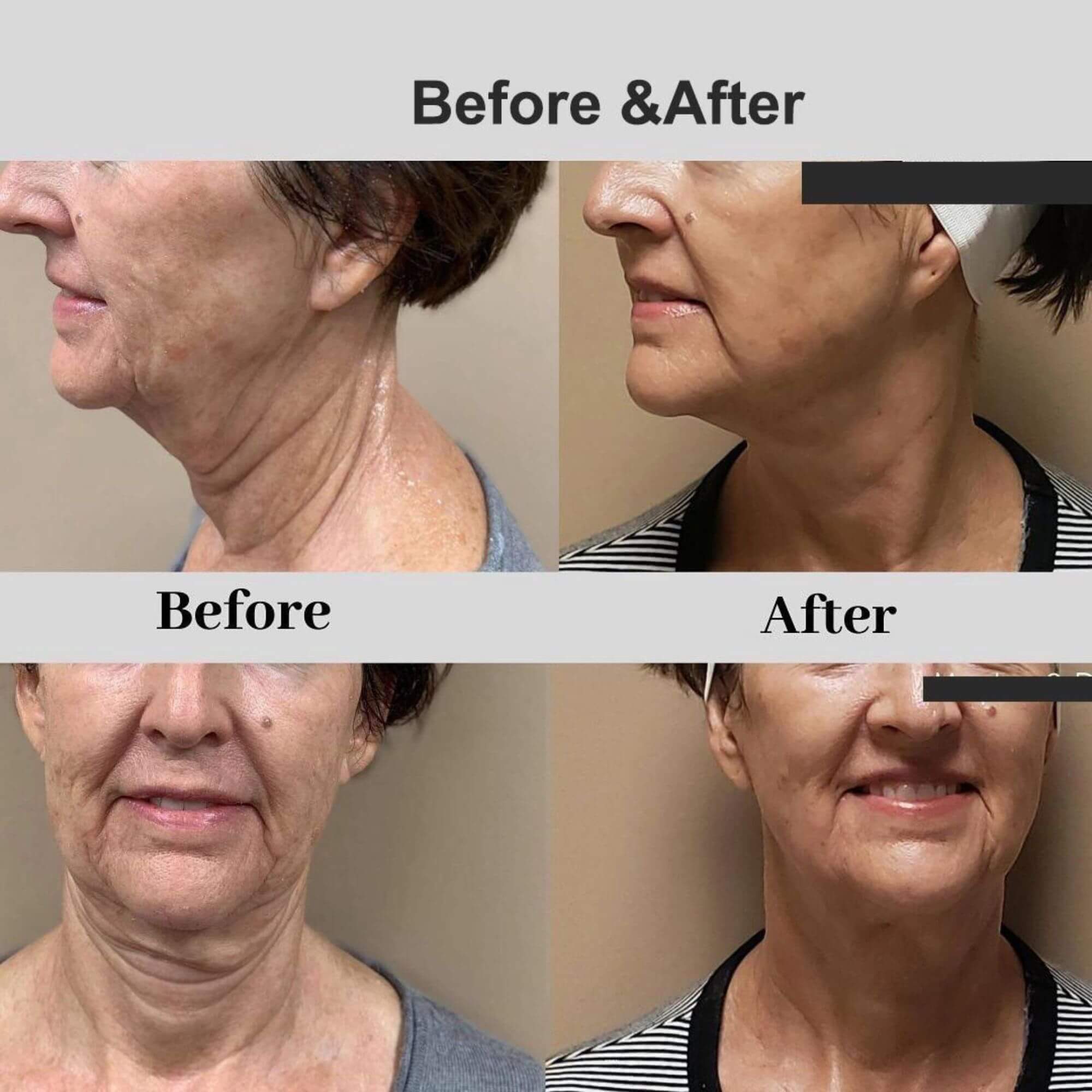 At-Home RF Microneedling Machine for Wrinkles, Scars, and Skin Firming (Max. 8mm Depth)