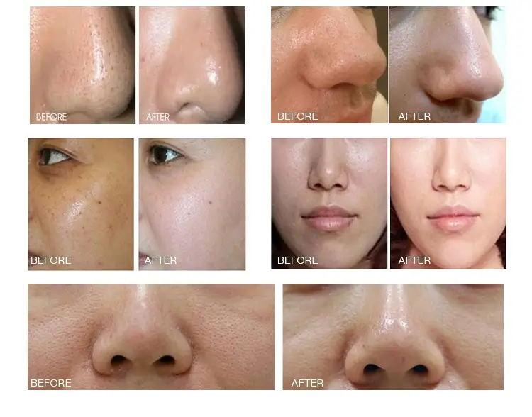 7 in 1 Facial Peeling Hydro Microdermabrasion Machine - Lazzybeauty