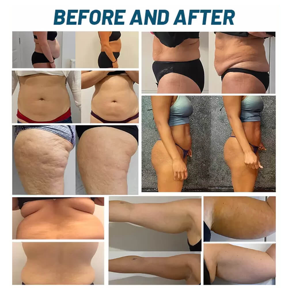 Cryolipolysis Machine – 5 Handle Cooling System