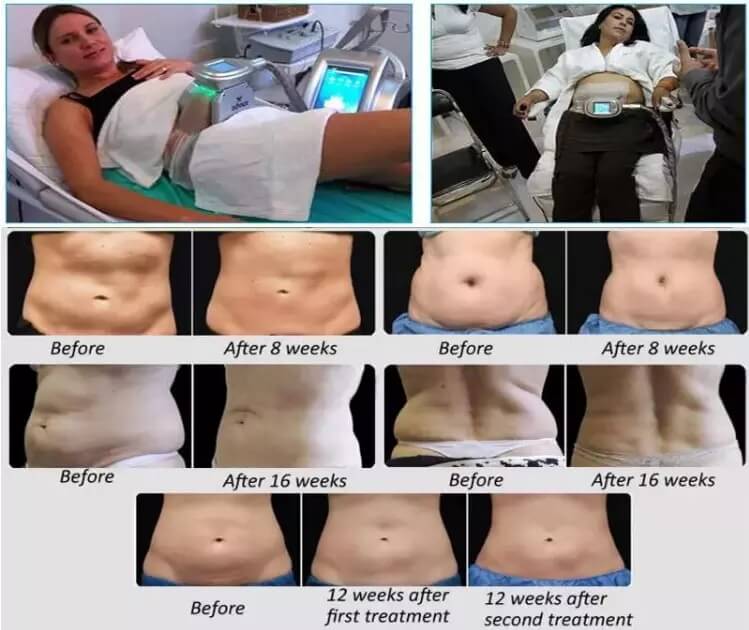 Cryo CoolSculpting Machine – 360° Lipo Fat Freezing